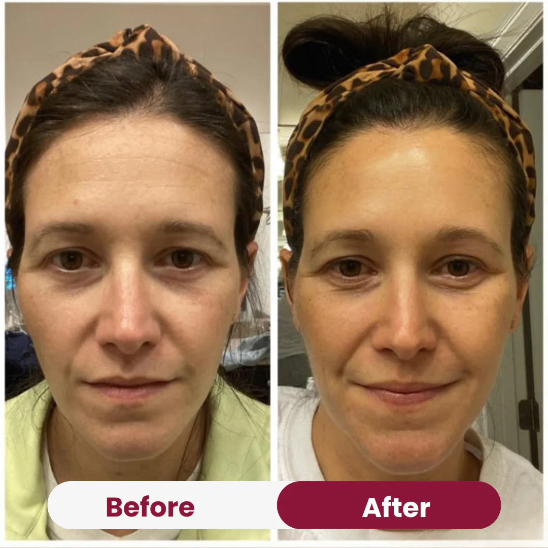 Wrinkle Forehead Patch - Image 7